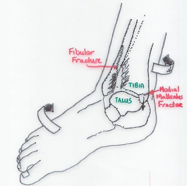 Foot Injury