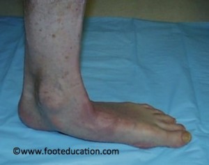 Adult Flatfoot Deformity