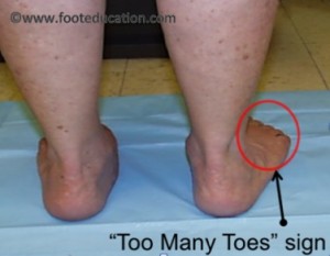 Adult Flatfoot Deformity