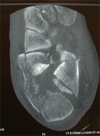 Calcaneus CT-Scan