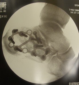 Calcaneus X-ray